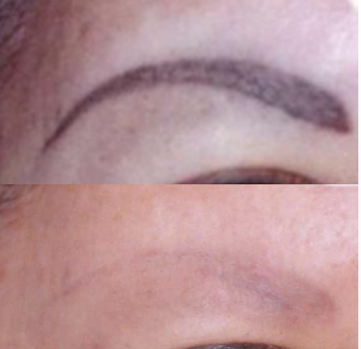 Antes y después del tratamiento