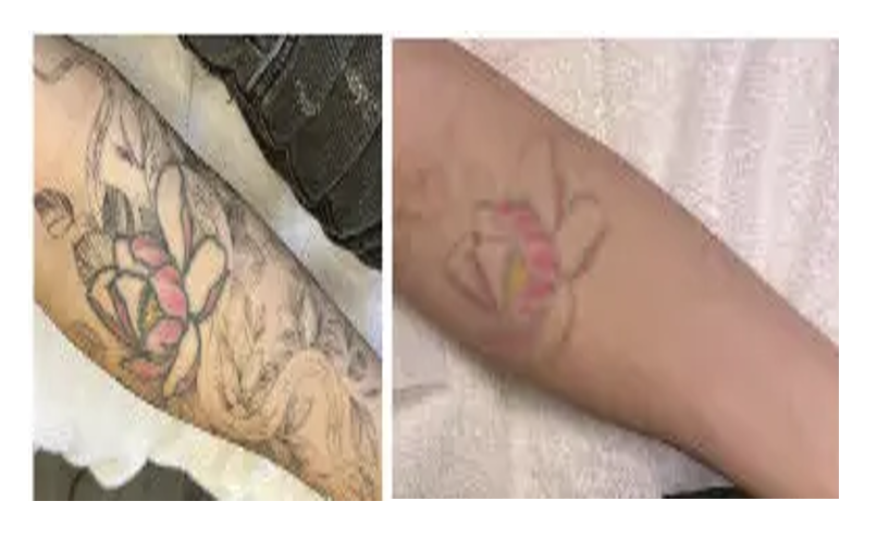 Antes y después del tratamiento
